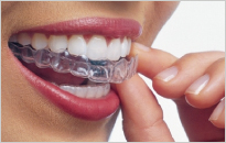 マウスピース矯正治療